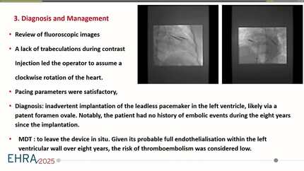Leadless Pacemaker in a Questionable Site for 8 Years