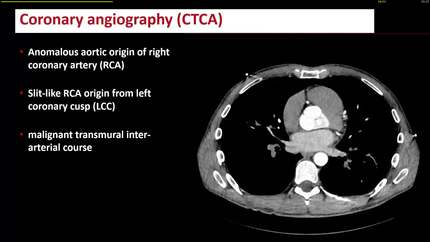 The uncommon PVC in an olympic athlete: a simple finding with serious consequences