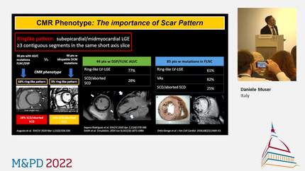 The non-ischemic scar: initial cardiomyopathy?
