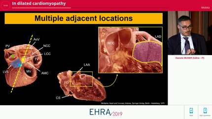 In dilated cardiomyopathy
