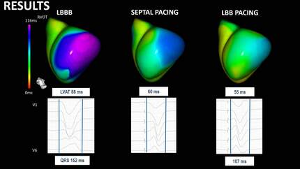 ECG imaging as a real time tool to guide left bundle branch pacing implant in patients with left bundle branch block and resynchronization therapy indication