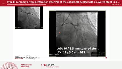 Type III coronary artery perforation after PCI of the ostial LAD, sealed with a covered stent in a left main simultaneous kissing stent technique.