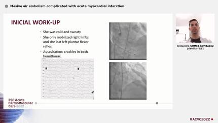 Masive air embolism complicated with acute myocardial infarction.