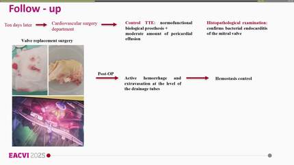 Complicated native valve infective endocarditis in a very elderly patient