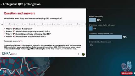 Ambiguous QRS prolongation
