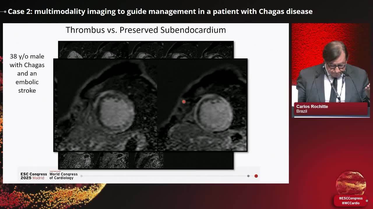 Clinical Case Management: how multimodality imaging guides management in inflammatory cardiomyopathy