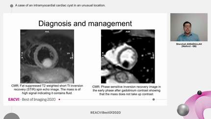 A case of an intramyocardial cardiac cyst in an unusual location.