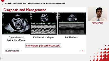 Cardiac Tamponade as a complication of Graft Intolerance Syndrome.