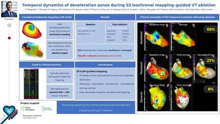 Temporal dynamics of deceleration zones during S3 isochronal mapping-guided VT ablation
