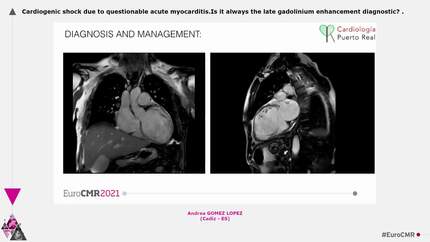 Cardiogenic shock due to questionable acute myocarditis.Is it always the late gadolinium enhancement diagnostic?
.