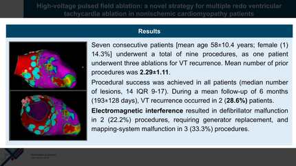 High-voltage pulsed field ablation: a novel strategy for multiple redo ventricular tachycardia ablation in nonischemic cardiomyopathy patients