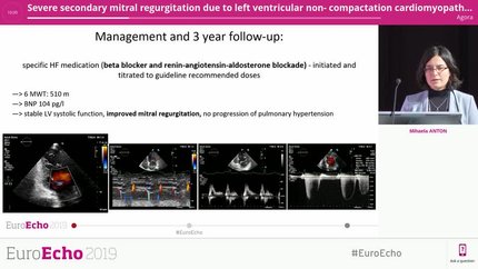Severe secondary mitral regurgitation due to left ventricular non- compactation cardiomyopathy- a rare cause of heart failure