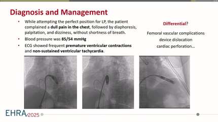 A Rare Complication: Leadless Pacemaker Implantation in the Left Ventricle with Early Identification and Correction