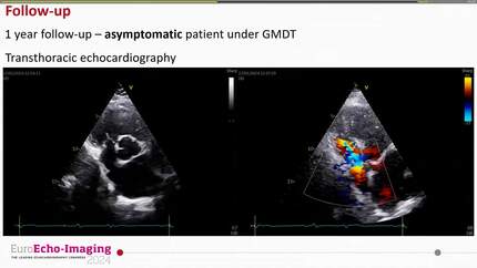 An unusual complication of ICD implantation and reimplantation in a patient with dilated cardiomyopathy