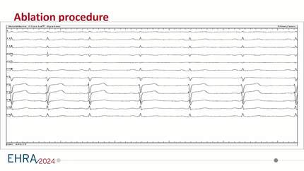 Focal pulsed field ablation: a novel therapeutic modality for premature ventricular contractions originating from the papillary muscle