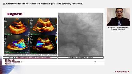 Radiation-induced heart disease presenting as acute coronary syndrome.