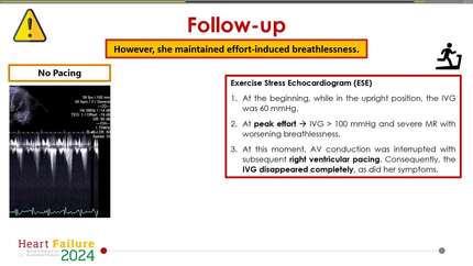 Exercise-induced atrioventricular block and hypertrophic cardiomyopathy: can right ventricular pacing be just right?