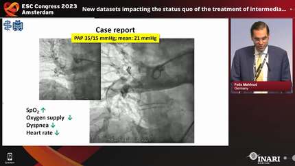 Why does an expanding data and product portfolio position lytic-free thrombectomy as the first choice for acute pulmonary embolism (PE) treatment? 