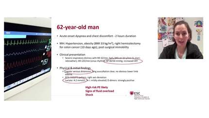 Treatment of severe PE: state of the art