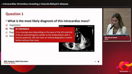 Intracardiac thrombus revealing a Vasculo-Behçet’s disease.