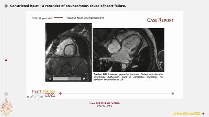 Constricted heart - a reminder of an uncommon cause of heart failure.