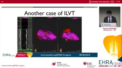 Identification of the circuit of idiopathic left ventricular tachycardia with ultra high density mapping