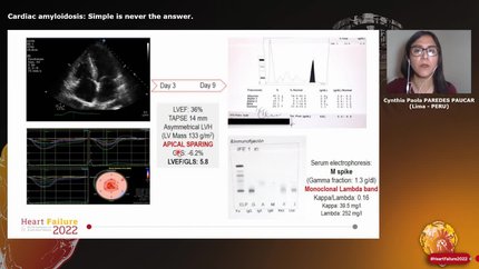 Cardiac amyloidosis: Simple is never the answer.