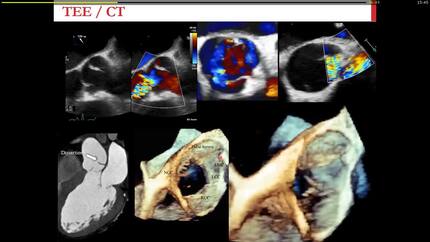 Symptomatic severe aortic regurgitation with coronary obstruction due to chronic type a dissection