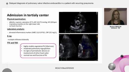 Delayed diagnosis of pulmonary valve infective endocarditis in a patient with recurring pneumonia.