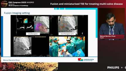 New eyes for the heart team: 3D ICE, fusion and AI-enabled device tracking for structural heart interventions