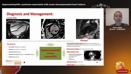 Hypereosinophilic syndrome associated with acute decompensated heart failure.