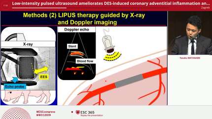 Low-intensity pulsed ultrasound ameliorates DES-induced coronary adventitial inflammation and hyperconstricting responses in pigs in vivo -A novel non-invasive therapy for coronary inflammation-