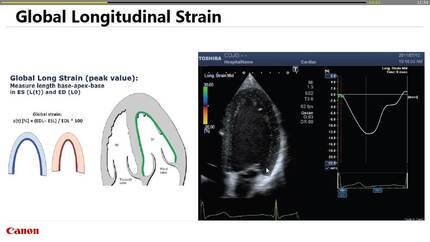 What is speckle tracking and what does it provide me to assess cardiac function?