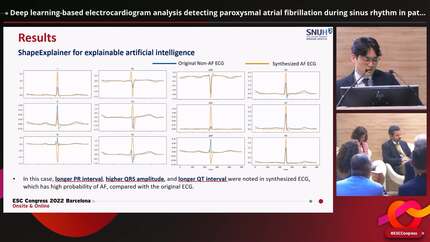 Deep learning-based electrocardiogram analysis detecting paroxysmal atrial fibrillation during sinus rhythm in patients with cryptogenic stroke : validation study using implantable cardiac monitoring