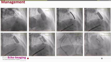The long journey of a tetralogy of Fallot patient