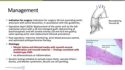From iliac aneurysm to aortic dissection: expanding the spectrum of fibromuscular dysplasia?