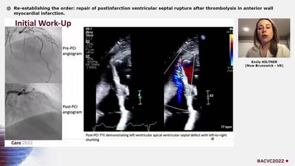 Re-establishing the order: repair of postinfarction ventricular septal rupture after thrombolysis in anterior wall myocardial infarction.