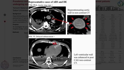 Prevalence and factors associated with the aortic ring sign in out-of-hospital cardiac arrest patients undergoing extracorporeal cardiopulmonary resuscitation