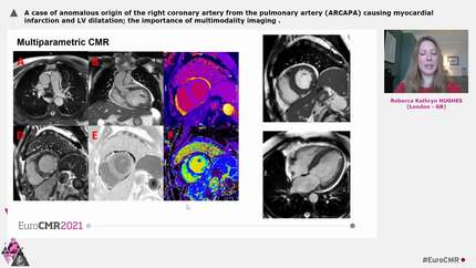 A case of anomalous origin of the right coronary artery from the pulmonary artery (ARCAPA) causing myocardial infarction and LV dilatation; the importance of multimodality imaging
.