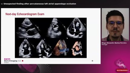 Unexpected finding after percutaneous left atrial appendage occlusion