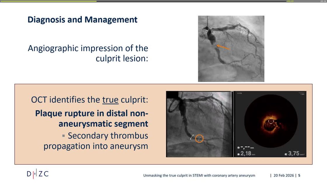 True Culprit ESC 365 - Unmasking the true culprit in STEMI with coronary artery aneurysm