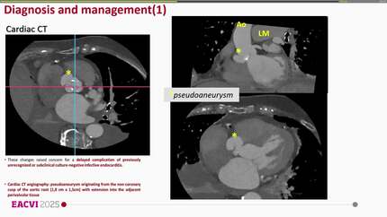 Silent endocarditis unveiled by aortic root pseudoaneurysm
