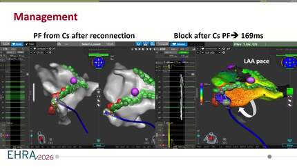 Intracardiac echocardiography-guided re-ablation of atrial fibrillation by dual-energy Lattice-tip catheter in a patient with a pulmonary vein stent 