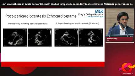 An unusual case of acute pericarditis with cardiac tamponade secondary to disseminated Neisseria gonorrhoeae infection.
