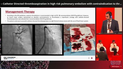 Clot in transit: pulmonary embolism cases explored