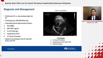Quarter Dose rtPA in an In-Transit Thrombus Complicating Pulmonary Embolism.