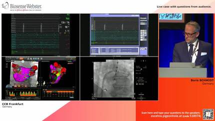 Radiofrequency (RF) energy and single shot device for pulmonary vein isolation (PVI): live case with HELIOSTAR™ balloon technology