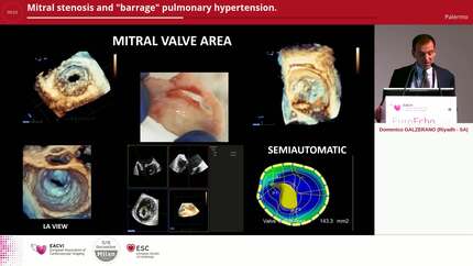 Mitral stenosis and "barrage" pulmonary hypertension.