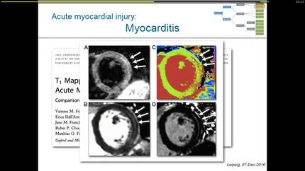 T1 mapping: methods and indications.