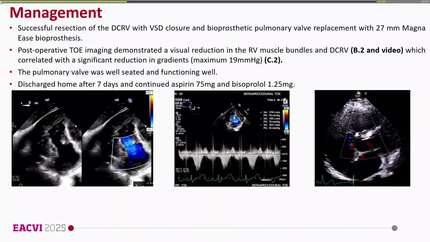 Small perimembranous VSD, a case of a not so simple lesion